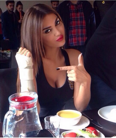 Yolanthe Cabau Wesley Sneijder WAG Broken hand