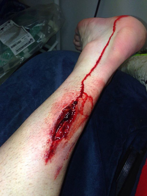 stephen ireland injury