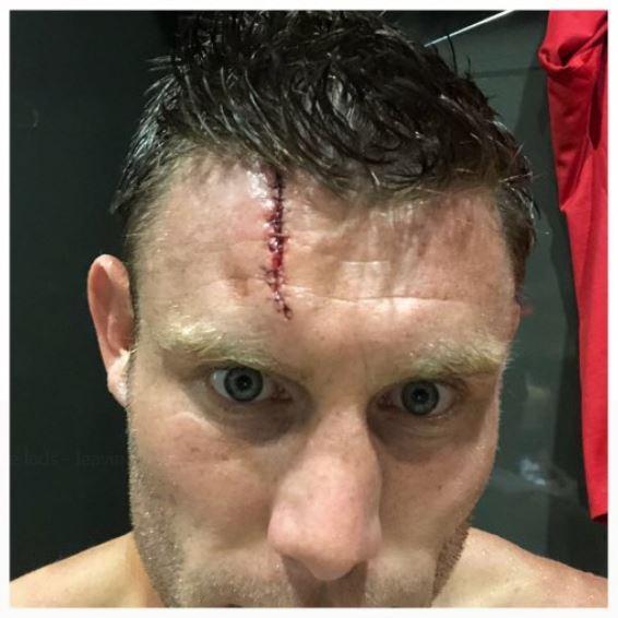 milner injury