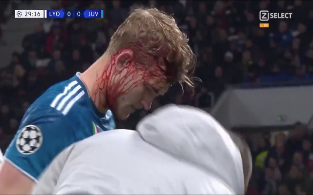 Video-De-Ligt-bleeding-for-Juventus