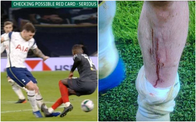 Video and Photo - Hojbjerg leg after horror red card tackle from Brentford's DaSilva